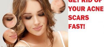 woman with acne scars logo